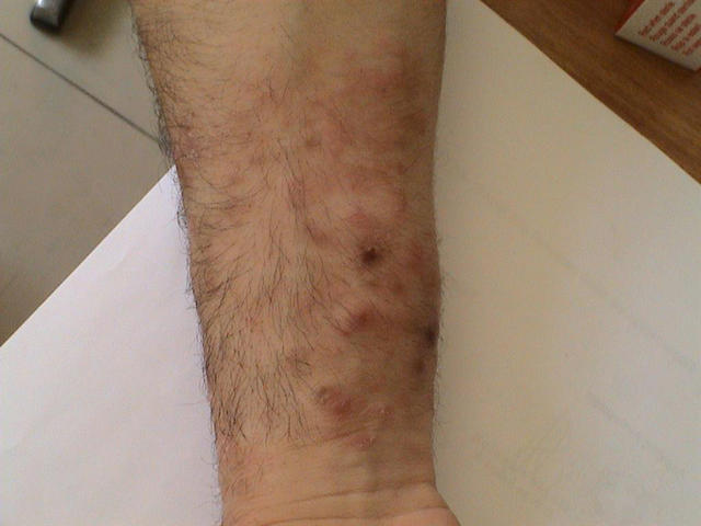 SUPERFICIAL FUNGAL INFECTIONS - Tinea infection SUPERFICIAL FUNGAL INFECTIONS - Tinea infection