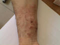 SUPERFICIAL FUNGAL INFECTIONS - Tinea infection