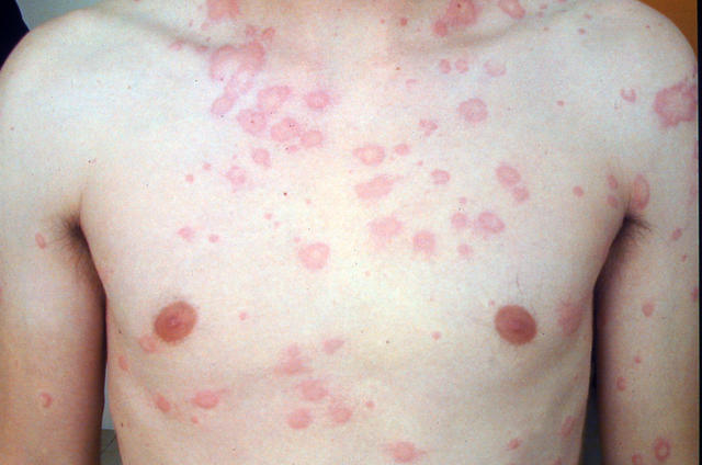 URTICARIA - Urticaria URTICARIA - Urticaria