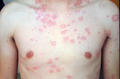 URTICARIA - Urticaria