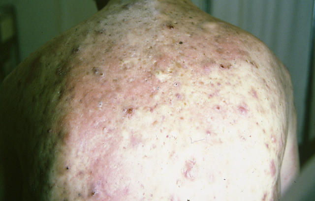 DISEASES OF THE SEBACEOUS GLANDS - Sebocystoma