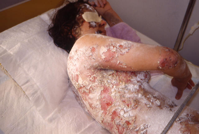 BULLOUS DISEASES - Pemphigus vulgaris BULLOUS DISEASES - Pemphigus vulgaris