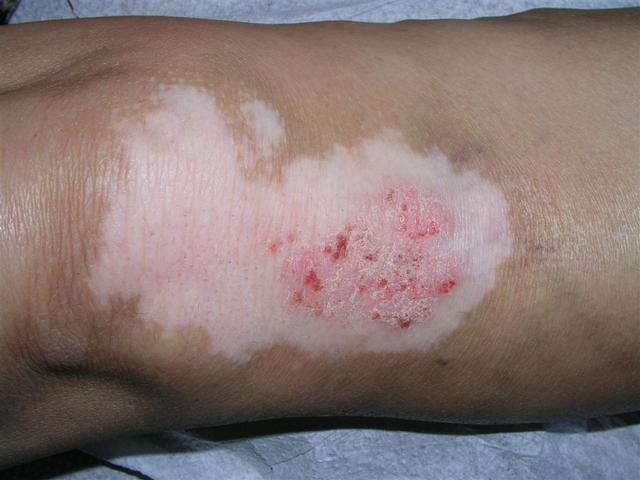 PSORIASIS - Psoriasis on vitiligo lesion PSORIASIS - Psoriasis on vitiligo lesion