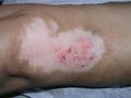 PSORIASIS - Psoriasis on vitiligo lesion