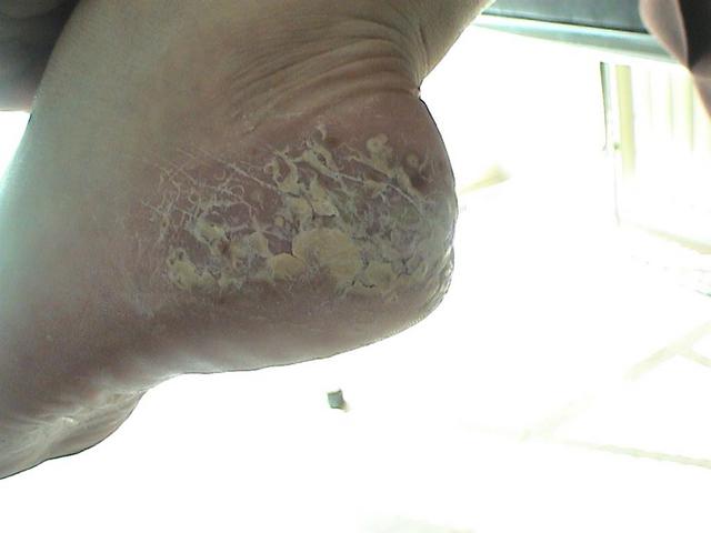 PSORIASIS - Psoriasis PSORIASIS - Psoriasis