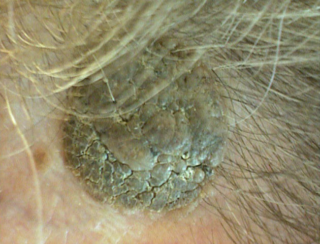 BENIGN SKIN LESIONS, NEVI, CYSTS - Seborrheic keratosis BENIGN SKIN LESIONS, NEVI, CYSTS - Seborrheic keratosis