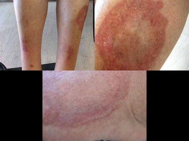 NECROBIOTIC DISORDERS - Necrobiosis lipoidica NECROBIOTIC DISORDERS - Necrobiosis lipoidica