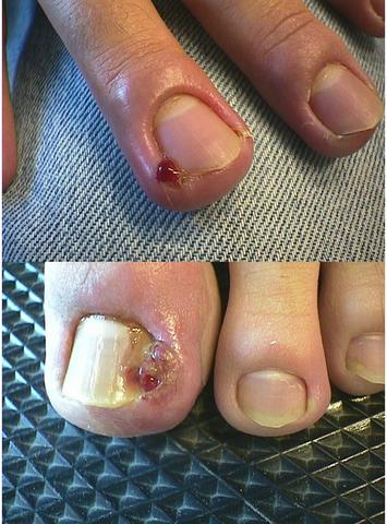 DRUG ERUPTIONS - Paronychia and pyogenic granuloma due to systemic isotretinoin