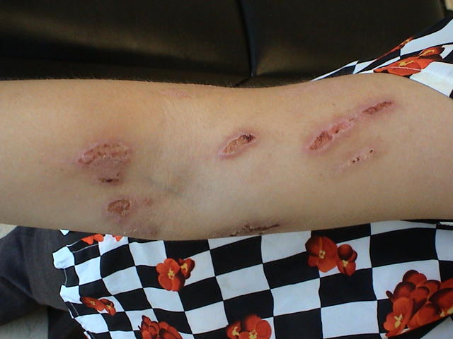 FACTICIAL LESIONS - Factitious lesions in a neurotic patient