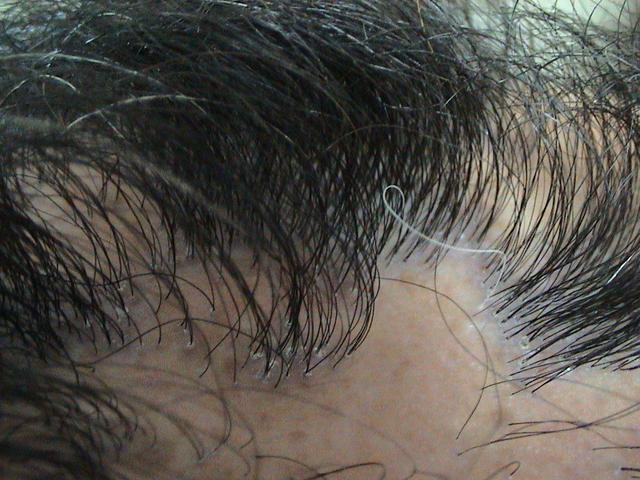 LICHEN - Lichen planopilaris of the scalp LICHEN - Lichen planopilaris of the scalp