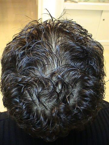 HAIR DISEASES - Androgenetic alopecia