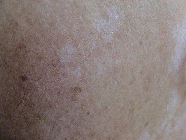 DERMATITIS - EKZEMA - Pityriasis alba DERMATITIS - EKZEMA - Pityriasis alba