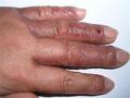 DERMATITIS - EKZEMA - Dermatitis from fig-tree