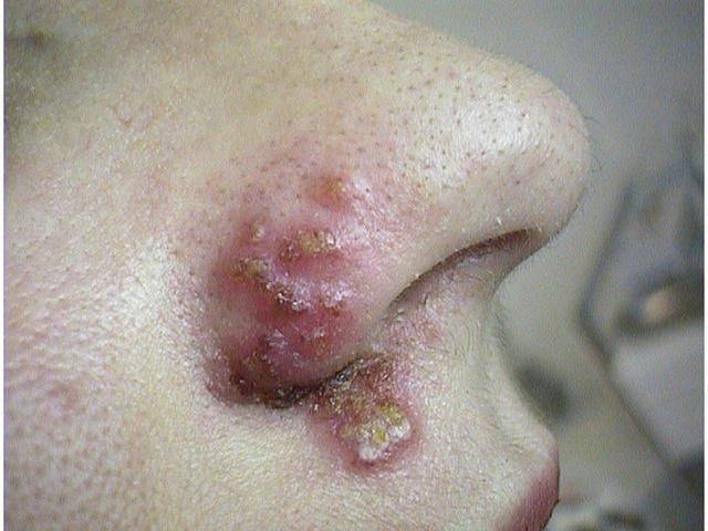 VIRAL INFECTIONS - Herpes Simplex