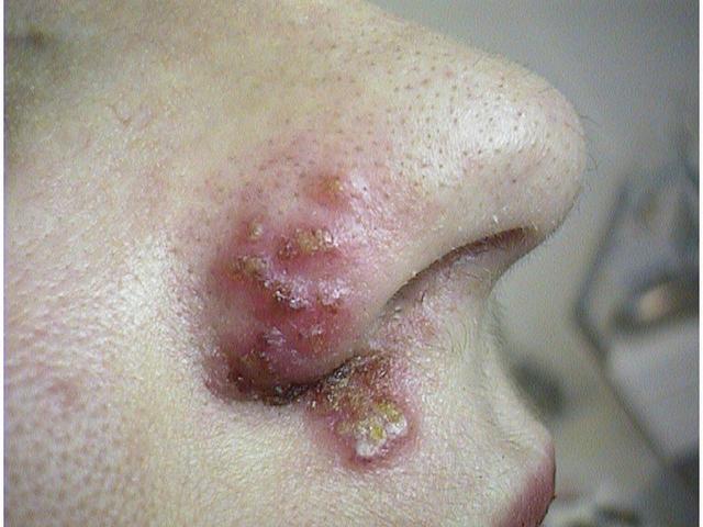VIRAL INFECTIONS - Herpes Simplex VIRAL INFECTIONS - Herpes Simplex