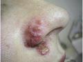 VIRAL INFECTIONS - Herpes Simplex