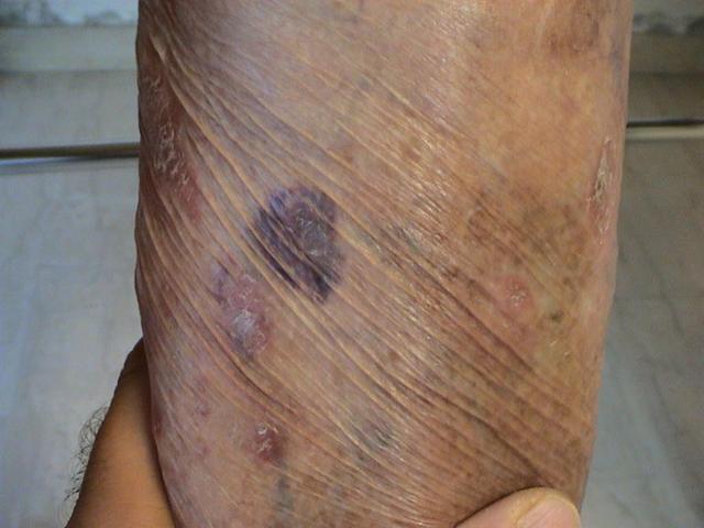 DRUG ERUPTIONS - Ecchymoses due to topical corticosteroids DRUG ERUPTIONS - Ecchymoses due to topical corticosteroids