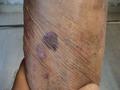 DRUG ERUPTIONS - Ecchymoses due to topical corticosteroids