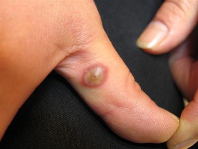VIRAL INFECTIONS - Orf disease VIRAL INFECTIONS - Orf disease