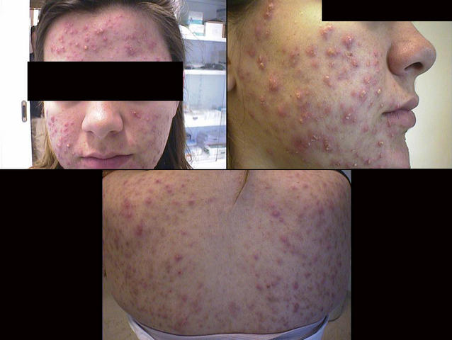 DISEASES OF THE SEBACEOUS GLANDS - Acne, inflammatory