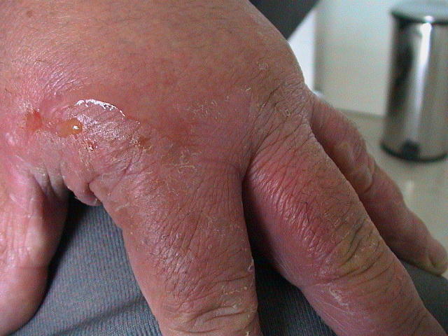 DERMATITIS - EKZEMA - Dermatitis from fig-tree DERMATITIS - EKZEMA - Dermatitis from fig-tree