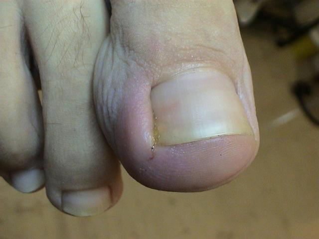 NAIL DISEASES - Acute paronychia NAIL DISEASES - Acute paronychia