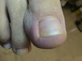 NAIL DISEASES - Acute paronychia