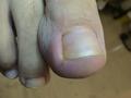 NAIL DISEASES - Acute paronychia