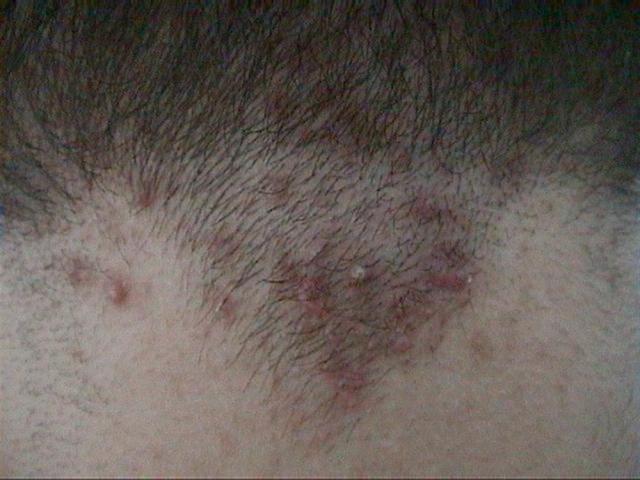 DISEASES OF THE SEBACEOUS GLANDS - Acne cheloidalis DISEASES OF THE SEBACEOUS GLANDS - Acne cheloidalis