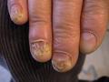 NAIL DISEASES - Onychomycosis due to Candida albicans infection