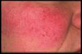 DISEASES OF THE SEBACEOUS GLANDS - Rosacea