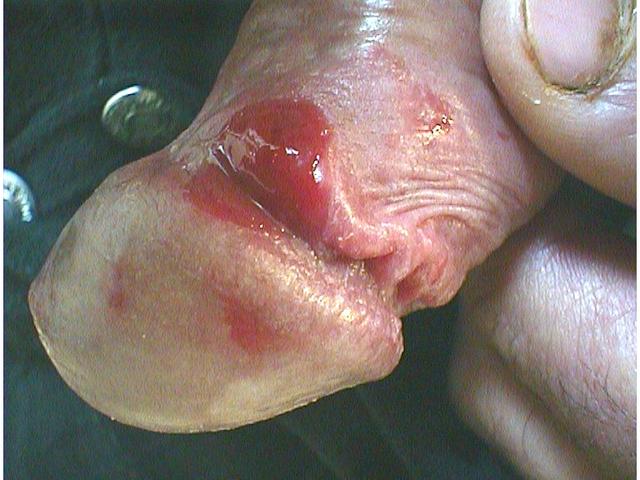 SYPHILIS AND OTHER SEXUAL TRANSMITTED DISEASES - Ulcer, primary syphilis