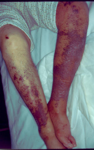 SOFT TISSUE TUMORS - Kaposi sarcoma SOFT TISSUE TUMORS - Kaposi sarcoma