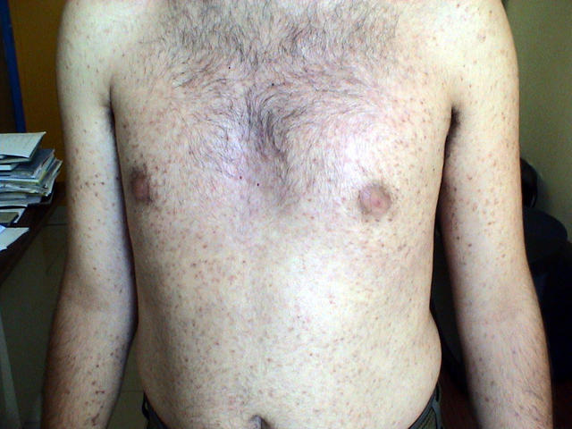 MASTOCYTOSES - Urticaria Pigmentosa