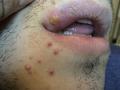 VIRAL INFECTIONS - Herpes labialis