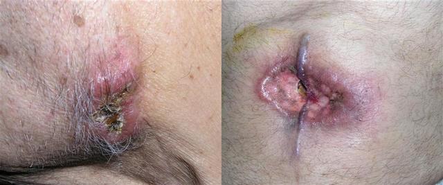METASTATIC LESIONS - Lung cancer, metastases
