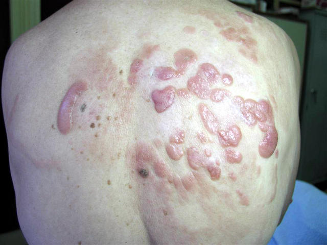 LYMPHOMAS - LYMPHOCYTIC INFILTRATIONS - B-cell Cutaneous Lymphoma