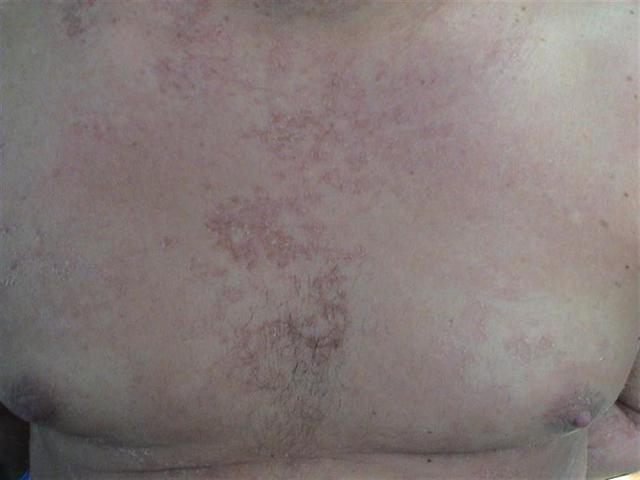 GENODERMATOSES - Netherton syndrome GENODERMATOSES - Netherton syndrome