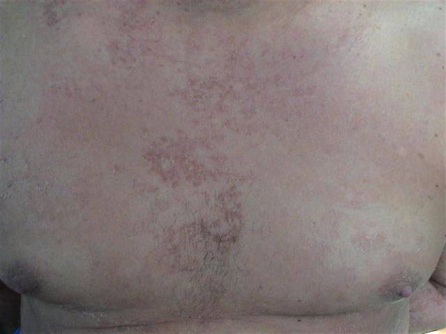 GENODERMATOSES - Netherton syndrome