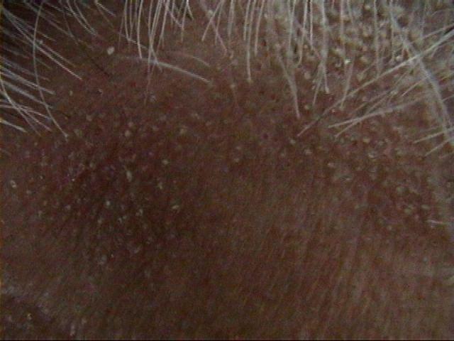 LICHEN - Lichen planopilaris of the scalp