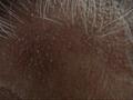 LICHEN - Lichen planopilaris of the scalp