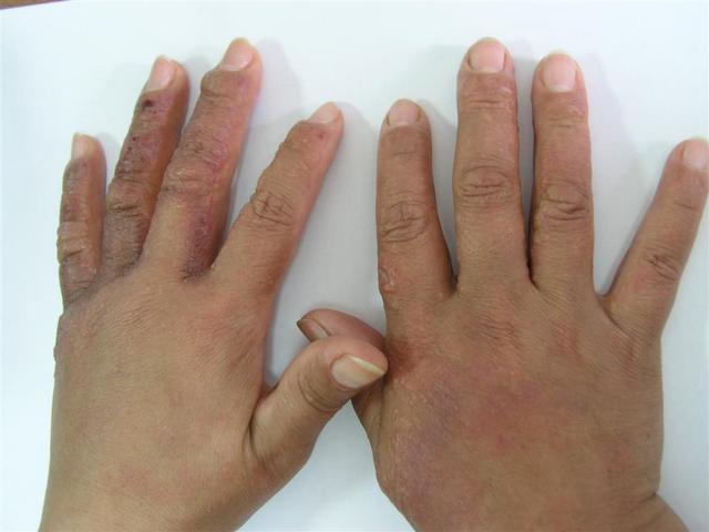 DERMATITIS - EKZEMA - Dermatitis from fig-tree