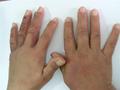 DERMATITIS - EKZEMA - Dermatitis from fig-tree