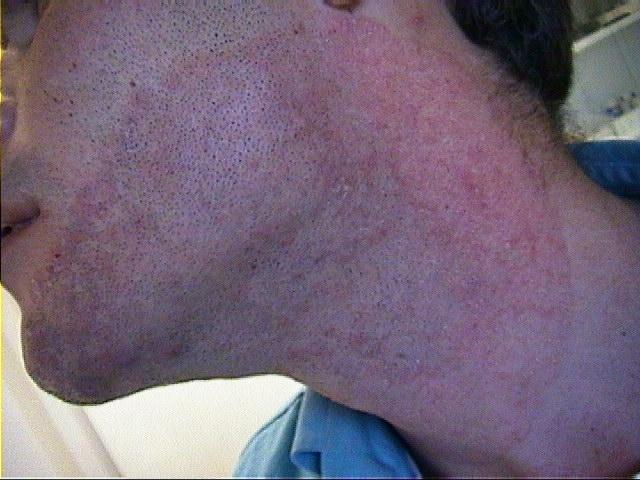 SUPERFICIAL FUNGAL INFECTIONS - Tinea faciale