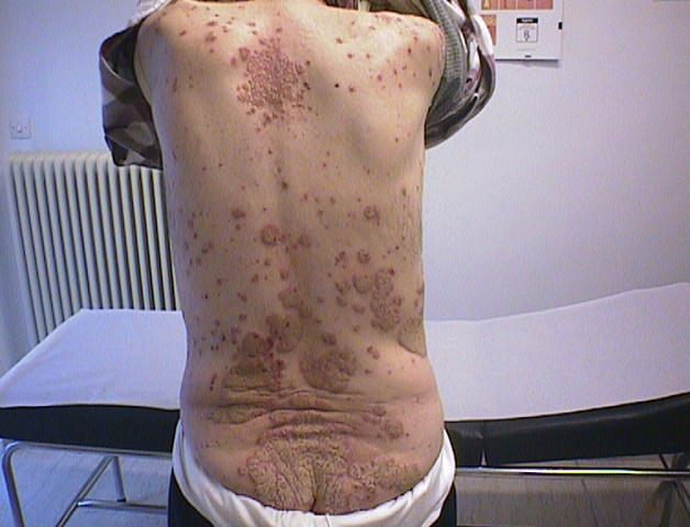 PSORIASIS - Generalized psoriasis PSORIASIS - Generalized psoriasis