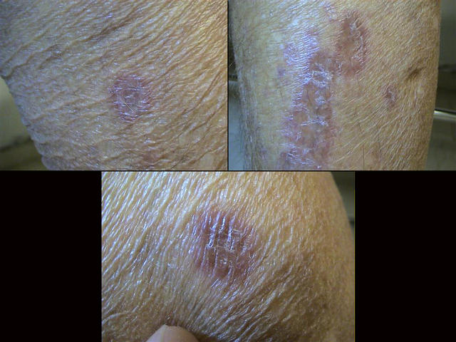 SARCOIDOSIS - Sarcoidosis SARCOIDOSIS - Sarcoidosis
