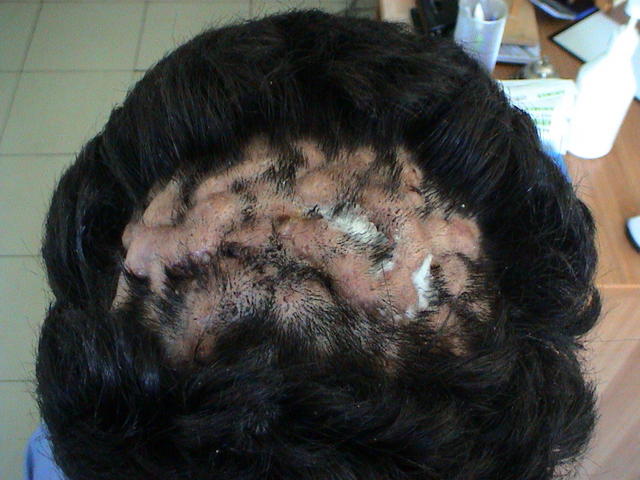 BACTERIAL INFECTIONS - Deep folliculitis BACTERIAL INFECTIONS - Deep folliculitis