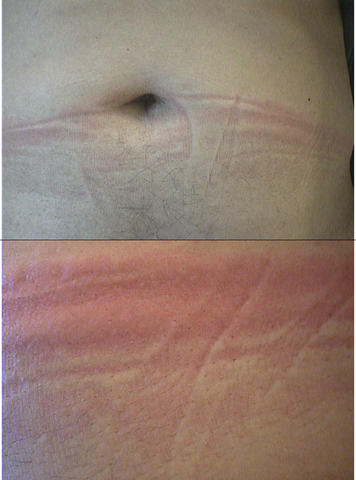 URTICARIA - Delayed pressure urticaria