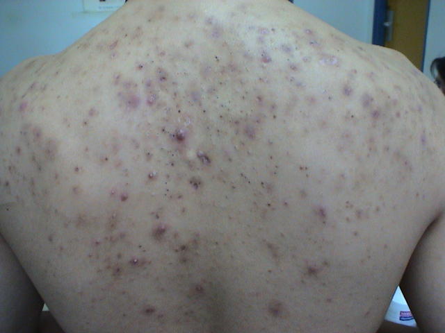 DISEASES OF THE SEBACEOUS GLANDS - Acne, Cystic DISEASES OF THE SEBACEOUS GLANDS - Acne, Cystic