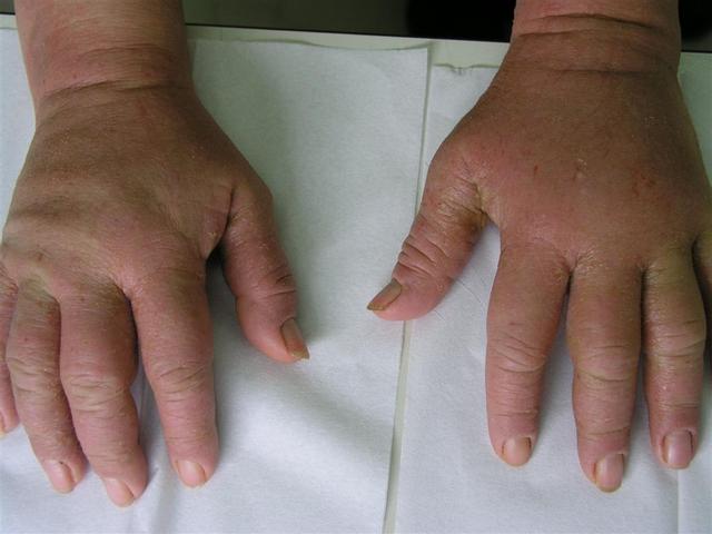 DERMATITIS - EKZEMA - Dermatitis DERMATITIS - EKZEMA - Dermatitis